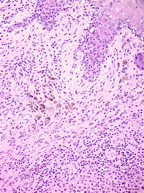 tumoral melanosis pathology outlines